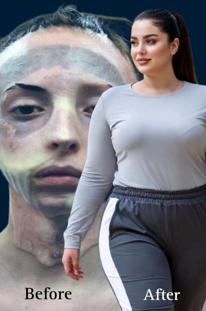 Face Transplantation