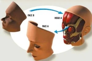 Face transplantation